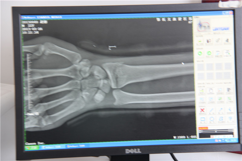 照片说明：通过鄂尔多斯蒙医正骨术治疗痊愈的X光片 摄影者：敖特根毕力格 时间：2013年3月26日..jpg